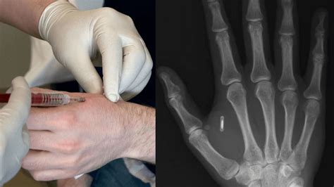 market research for rfid chips|chip implanted in the hand.